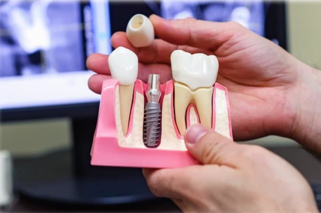 Зубные имплантаты: конструкция, производители