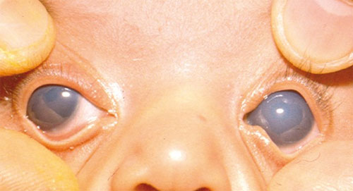 глаукома у новорожденных симптомы