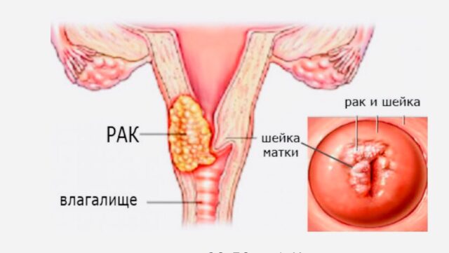 Злокачественные новообразования матки: диагностика и лечение