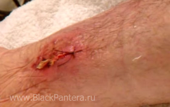Заговор на заживление раны