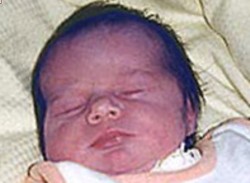 Цианоз новорожденных фото