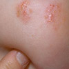 Аллергический дерматит у детей, симптомы и лечение