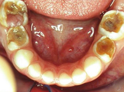 Кариес зубов может спровоцировать развитие более опасных болезней